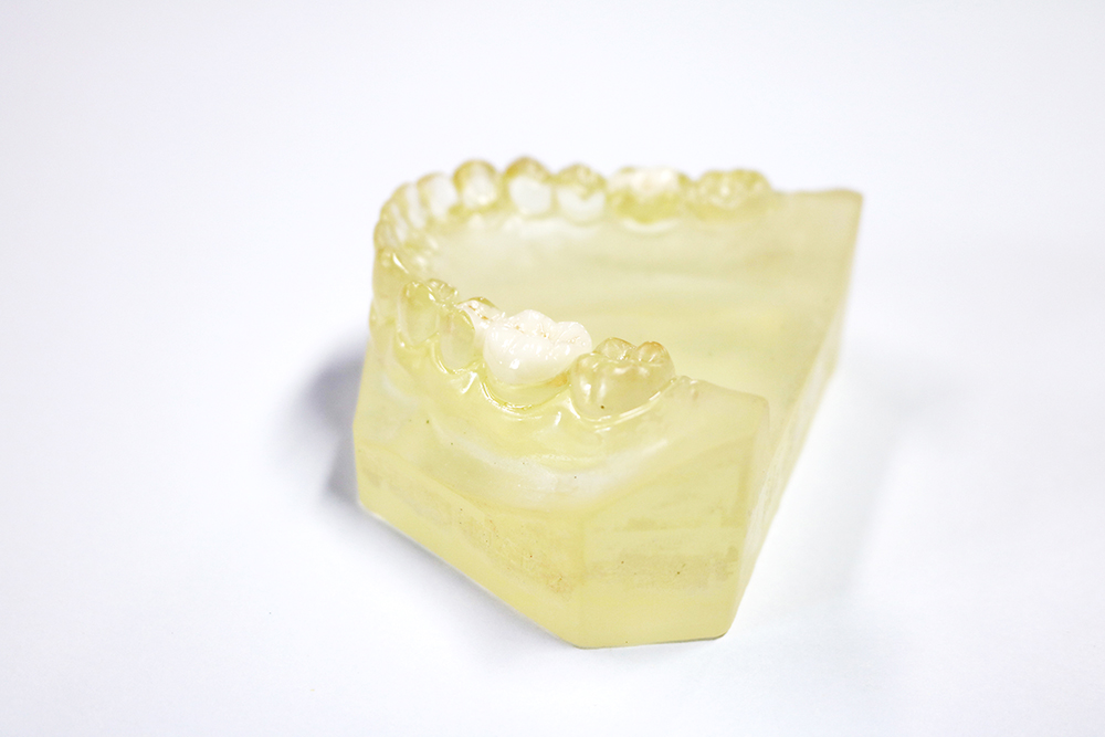 Porcelain Dental Inlay Onlay Zirconia Emax High Esthetics