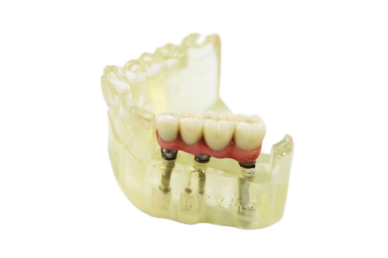 Dental Implants