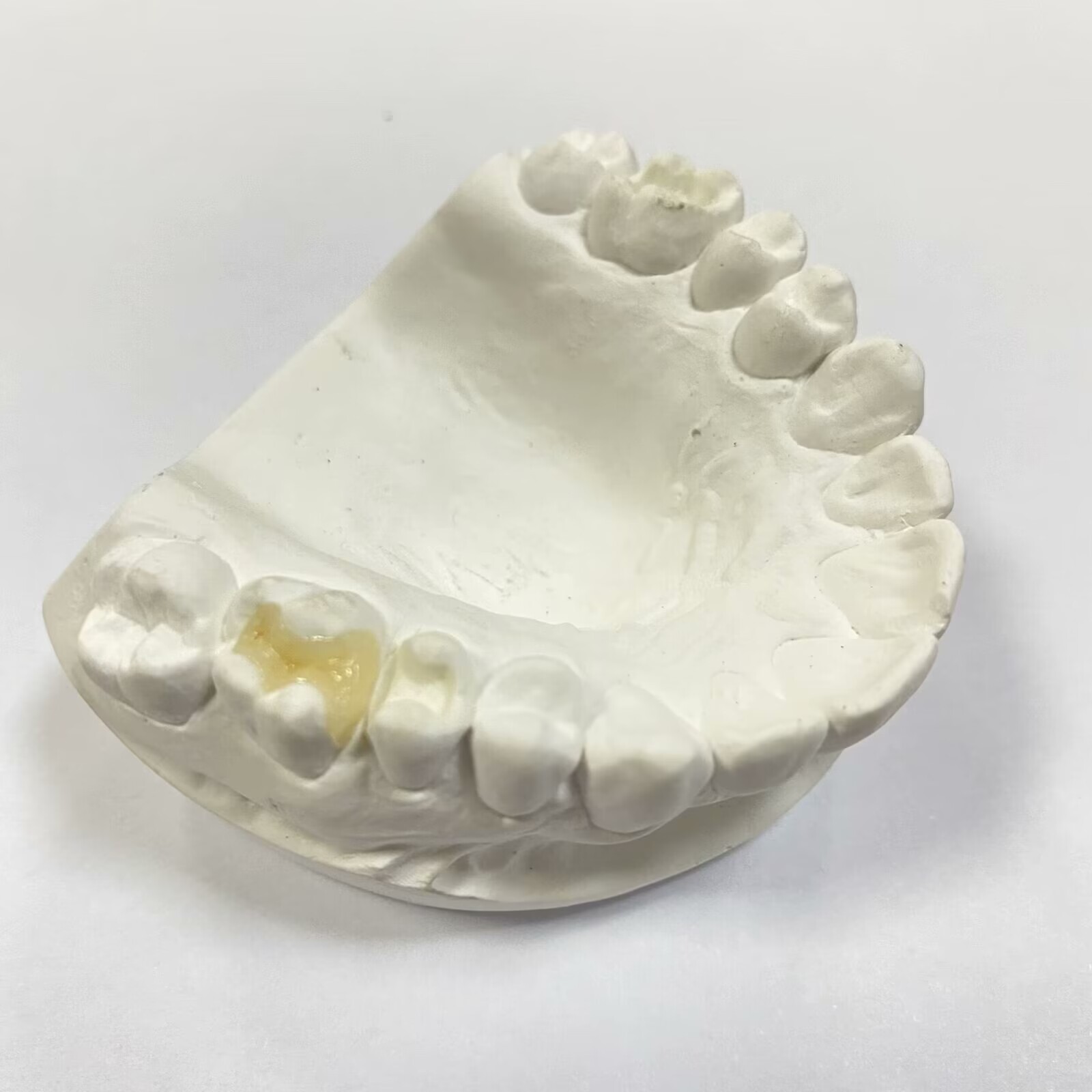 Composite Inlay onlay