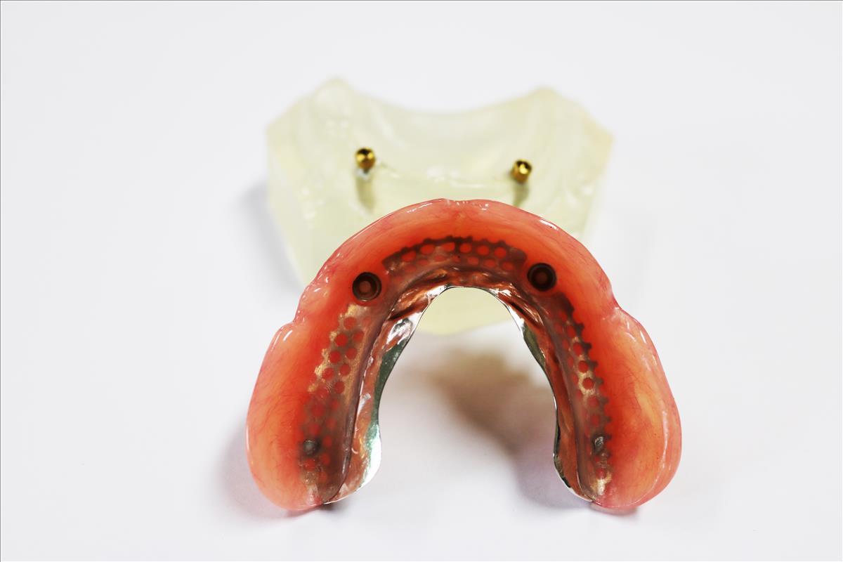 Dental Implant Locator Abutment Denture Teeth