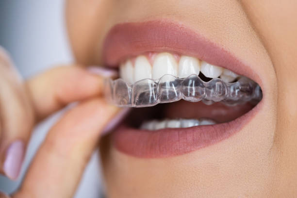 Clear Aligner Teeth Straightening