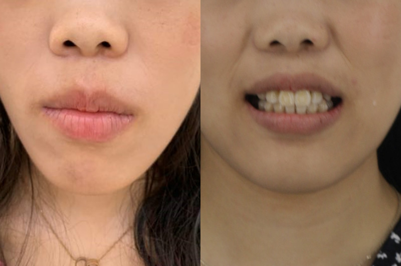 【Both jaws protrude】Invisible analytical diagnosis and corrective design