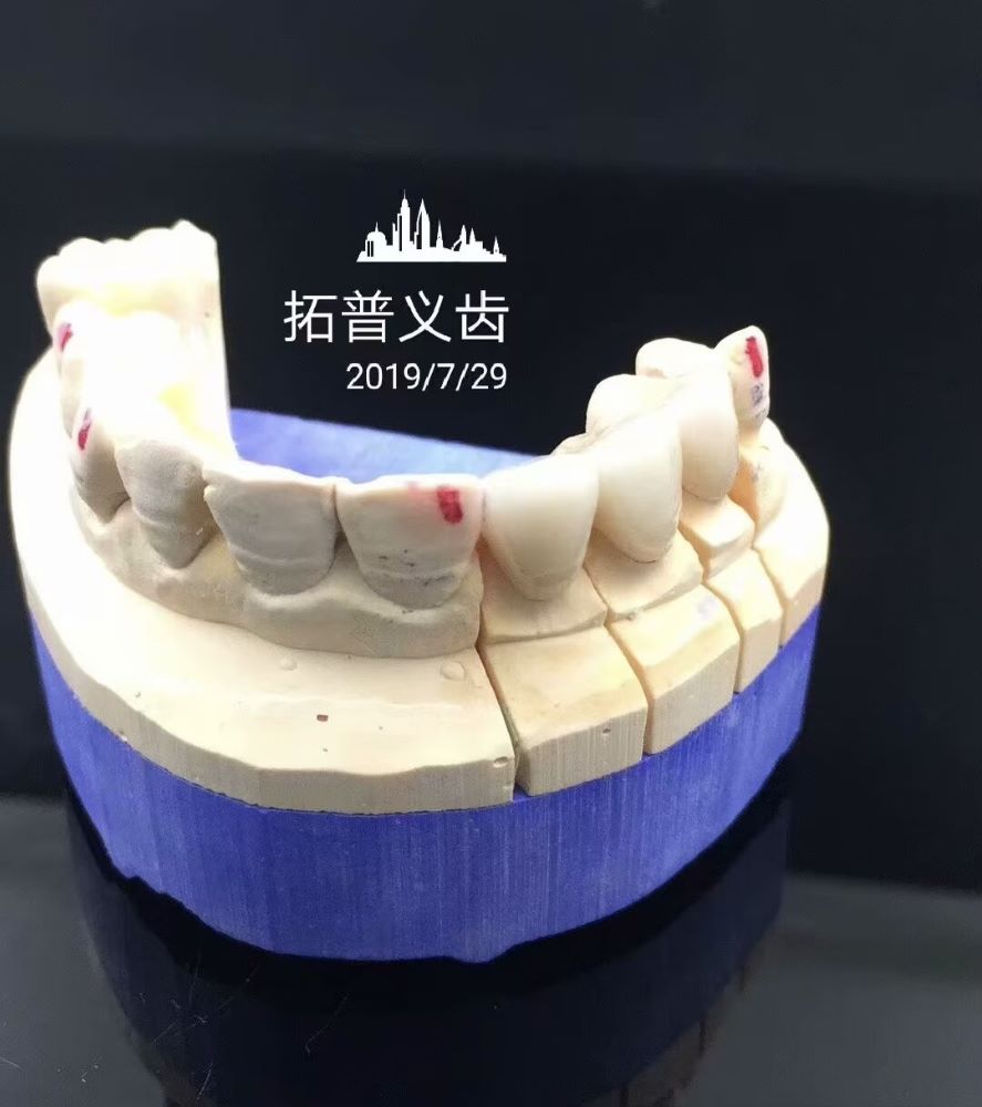 High Esthetics Zirconia Dental Lab Crowns Bridge With Layered Porcelain