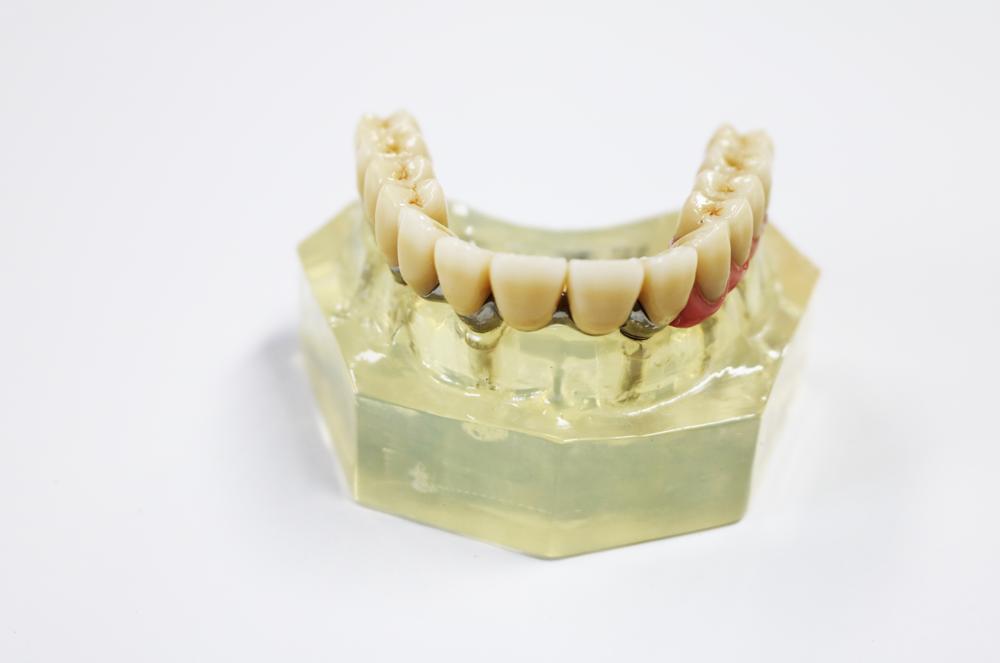 Zirconia Dental Implant Crown Biocompatible With Titanium Bar