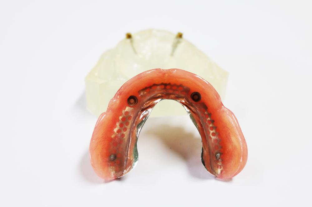 Dental Implant Locator Abutment Denture Teeth