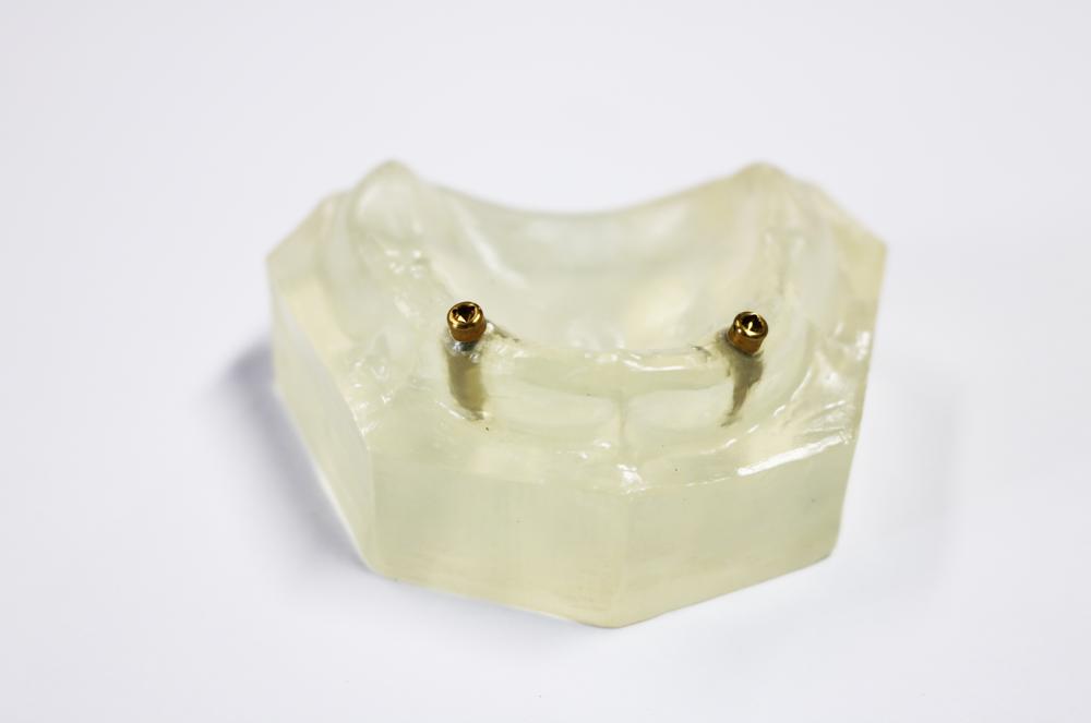 Dental Implant Locator Abutment