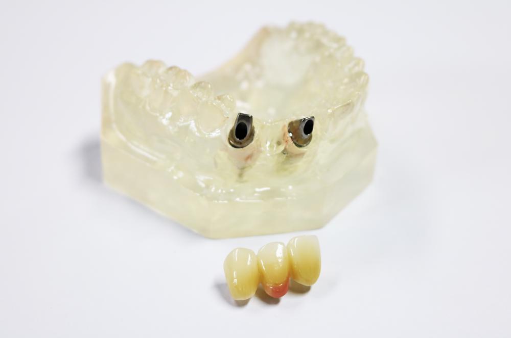 Implant abutment and zirconia all-ceramic bridge