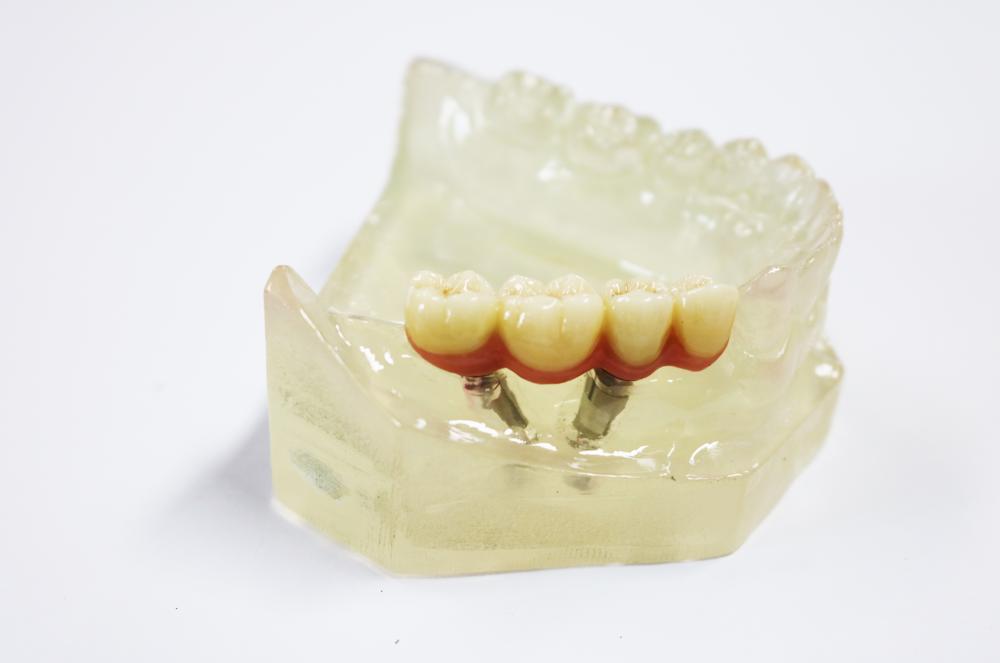 The customized abutment and zirconia complete crown bridge were used in the upper part of the implant