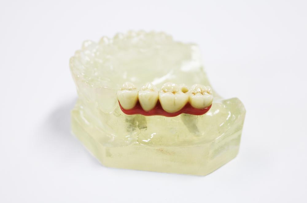 The customized abutment and zirconia complete crown bridge were used in the upper part of the implant