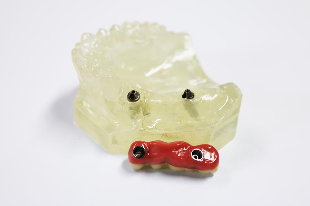 Implant abutment + pure titanium pontoon bridge + zirconia all-ceramic bridge