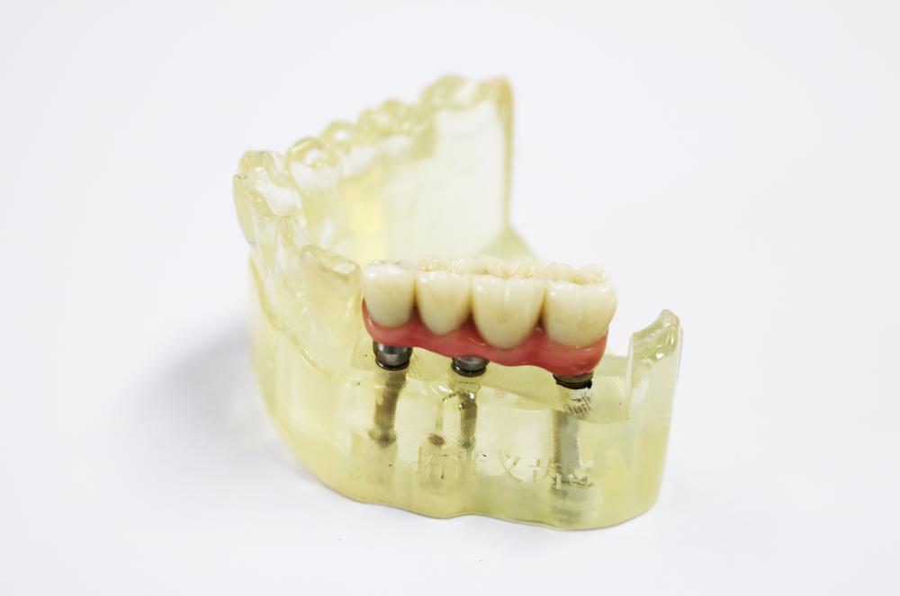 Implant abutment + pure titanium pontoon bridge + zirconia all-ceramic bridge