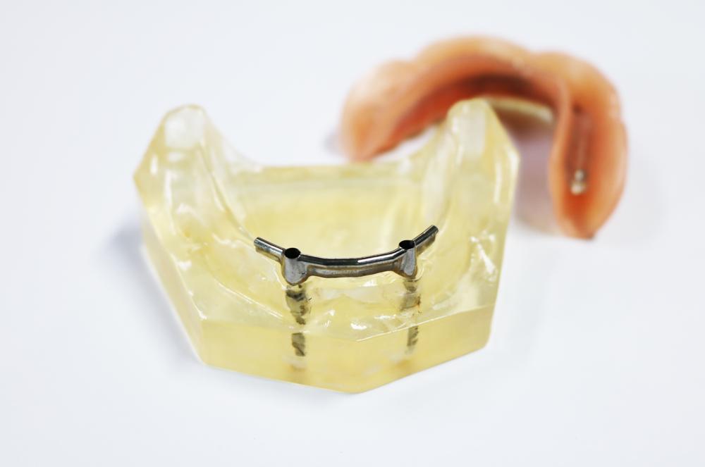 Implant the upper pure titanium rod card holder attachment Removable Denture