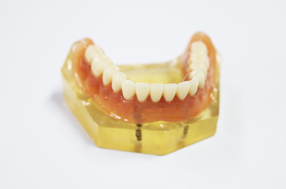 The upper part of the implant was pure titanium rod clip precision accessories + removable denture