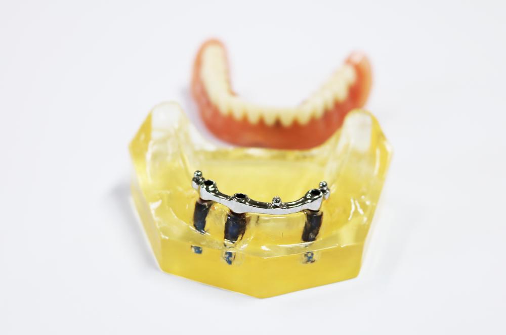Planting the upper co-cr alloy rod at precision ball attachment + removable denture
