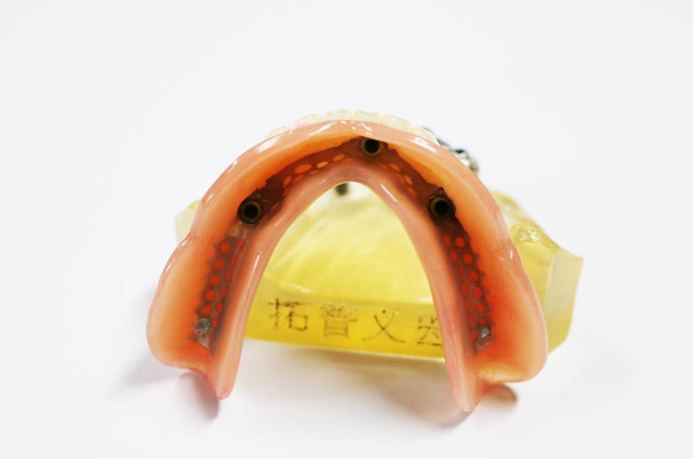 Planting the upper co-cr alloy rod at precision ball attachment + removable denture