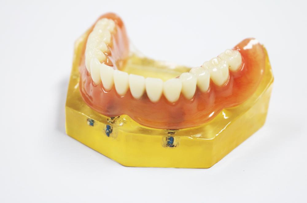 Planting the upper co-cr alloy rod at precision ball attachment + removable denture