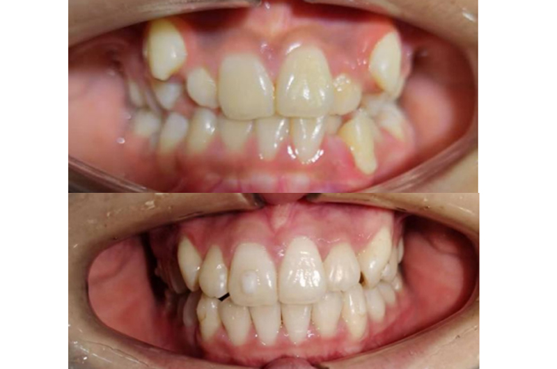 【Mixed dentition】Invisible analytical diagnosis and corrective design