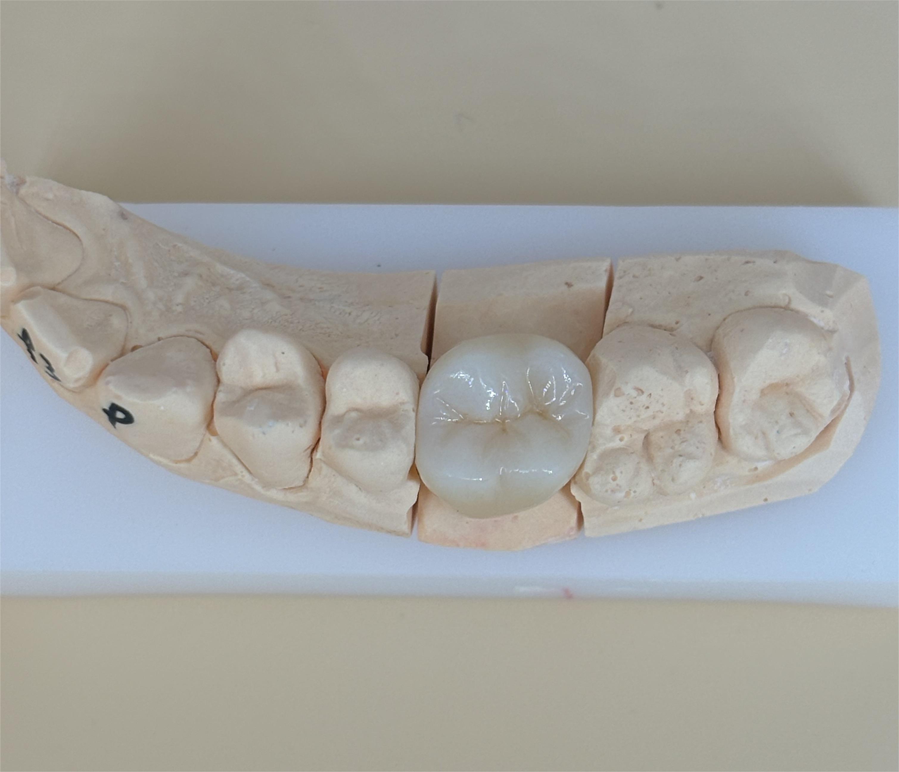 Ni Be Free Digital Dental Crowns Accurate Metal Ceramic Crowns