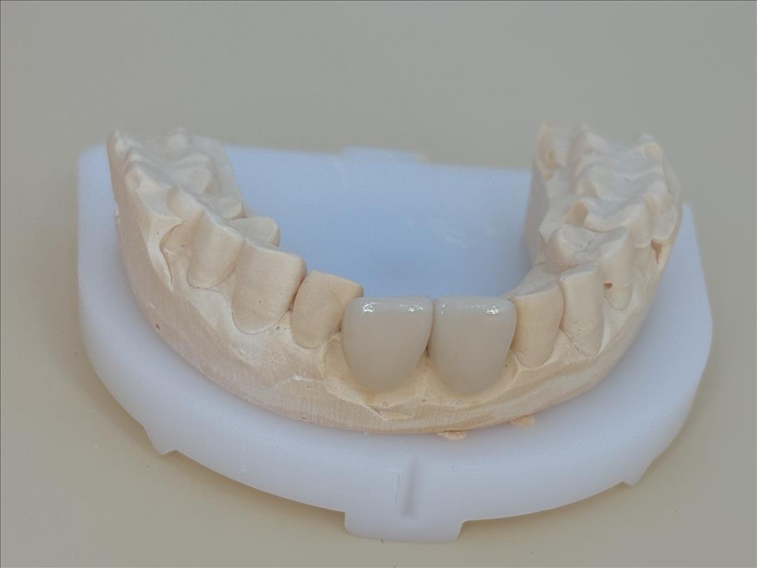 High Esthetic Teeth Emax Laminate Veneers Incisal Translucency