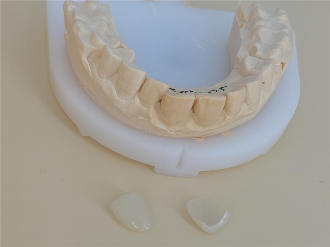 High Esthetic Teeth Emax Laminate Veneers Incisal Translucency