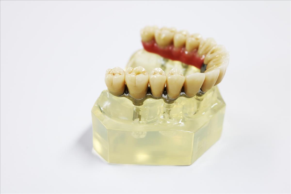 Zirconia Dental Implant Crown Biocompatible With Titanium Bar
