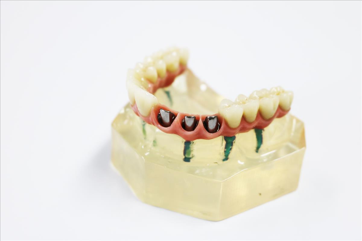 Zirconia Dental Implant Crown Biocompatible With Titanium Bar