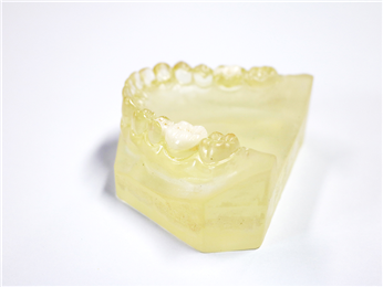 Porcelain Dental Inlay Onlay Zirconia Emax High Esthetics
