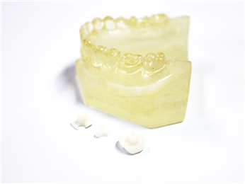 Porcelain Dental Inlay Onlay Zirconia Emax High Esthetics