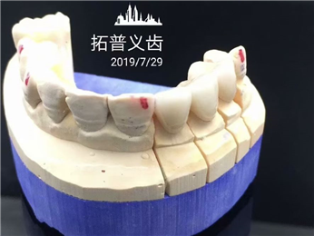 High Esthetics Zirconia Dental Lab Crowns Bridge With Layered Porcelain