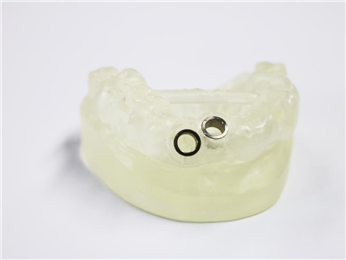 Digital implant (dental support) local half course guide plate