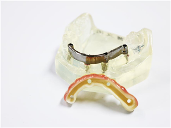 The upper part of the implant was a pure titanium bar-clip bridge with zirconia all-ceramic bridge