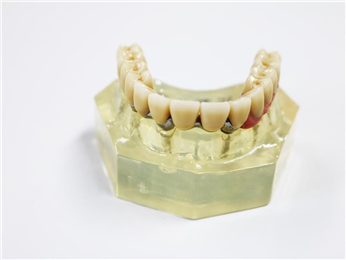 Zirconia Dental Implant Crown Biocompatible With Titanium Bar