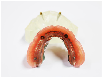 Dental Implant Locator Abutment Denture Teeth
