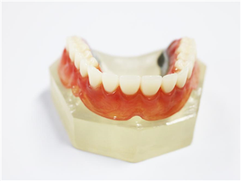 Dental Implant Locator Abutment Denture Teeth Designed and Milled
