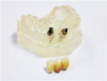 Implant abutment and zirconia all-ceramic bridge