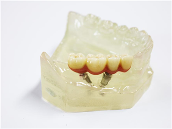 The customized abutment and zirconia complete crown bridge were used in the upper part of the implant