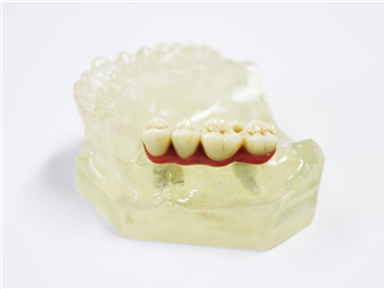The customized abutment and zirconia complete crown bridge were used in the upper part of the implant