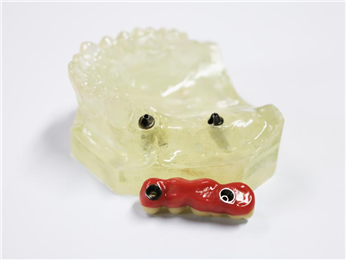 Implant abutment + pure titanium pontoon bridge + zirconia all-ceramic bridge