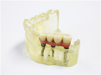 Implant abutment + pure titanium pontoon bridge + zirconia all-ceramic bridge