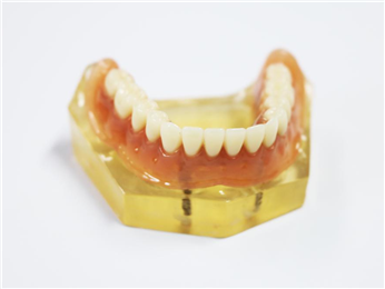 The upper part of the implant was pure titanium rod clip precision accessories + removable denture