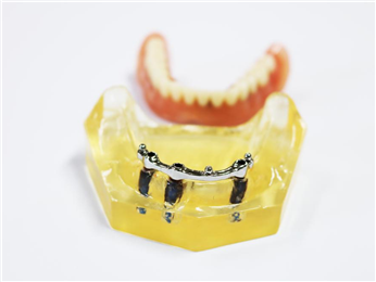 Planting the upper co-cr alloy rod at precision ball attachment + removable denture