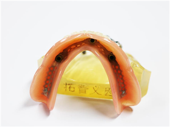 Planting the upper co-cr alloy rod at precision ball attachment + removable denture