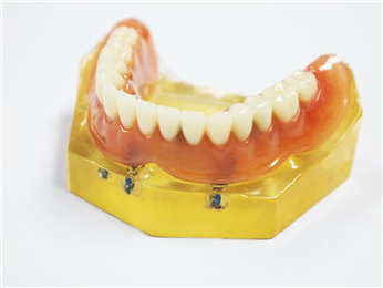 Planting the upper co-cr alloy rod at precision ball attachment + removable denture