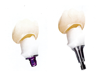 Dental Implant Crown Titanium Teeth Zirconia Crowns
