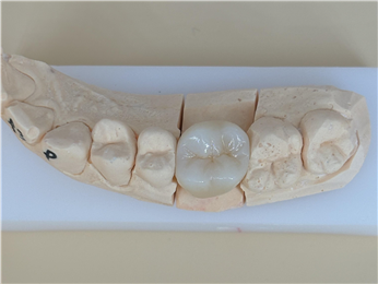Ni Be Free Digital Dental Crowns Accurate Metal Ceramic Crowns
