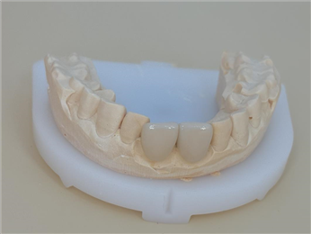 High Esthetic Teeth Emax Laminate Veneers Incisal Translucency