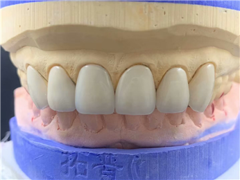Permanent Composite Emax Zirconia Laminate Veneers Dental Natural Looking Description